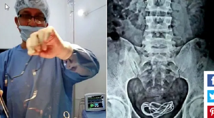 Doctors remove mobile phone charger from man’s bladder.